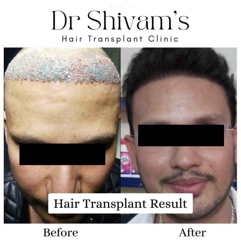 Hair Transplant Surgery Results