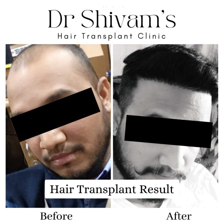 Hair Transplant Surgery Results