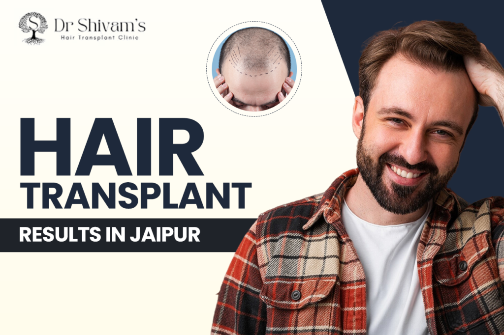 Hair Transplants result in Jaipur