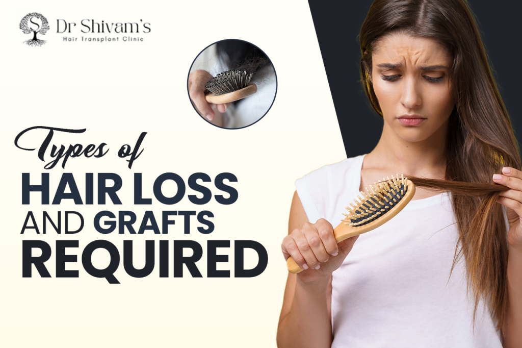 Types of Hair Loss and Grafts Required